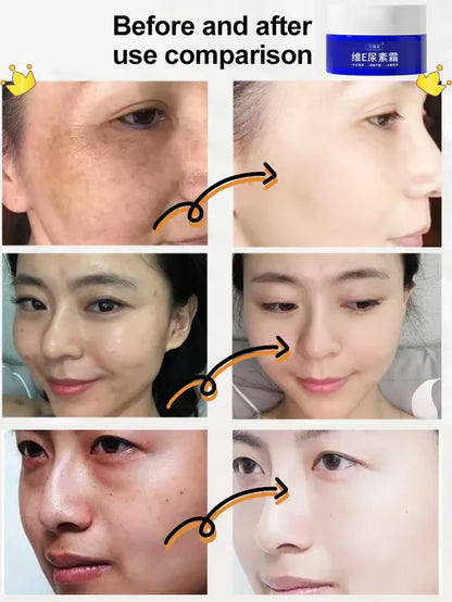 Spot Fading Urea Cream ( Buy 1 Get 1 )
